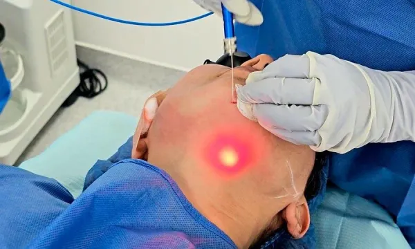 تطبيق ليزر Endolift تحت الذقن