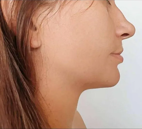 ملف جانبي بعد بروتوكول Saphir V-Line Sculpt™: زاوية الذقن والرقبة أُعيد رسمها والفك السفلي أكثر تحديداً