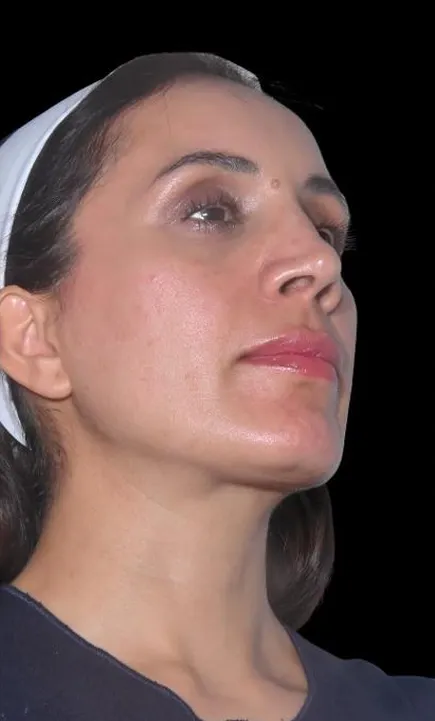 Bas du visage trois mois après Endolift : ovale redéfini et ligne mandibulaire plus nette
