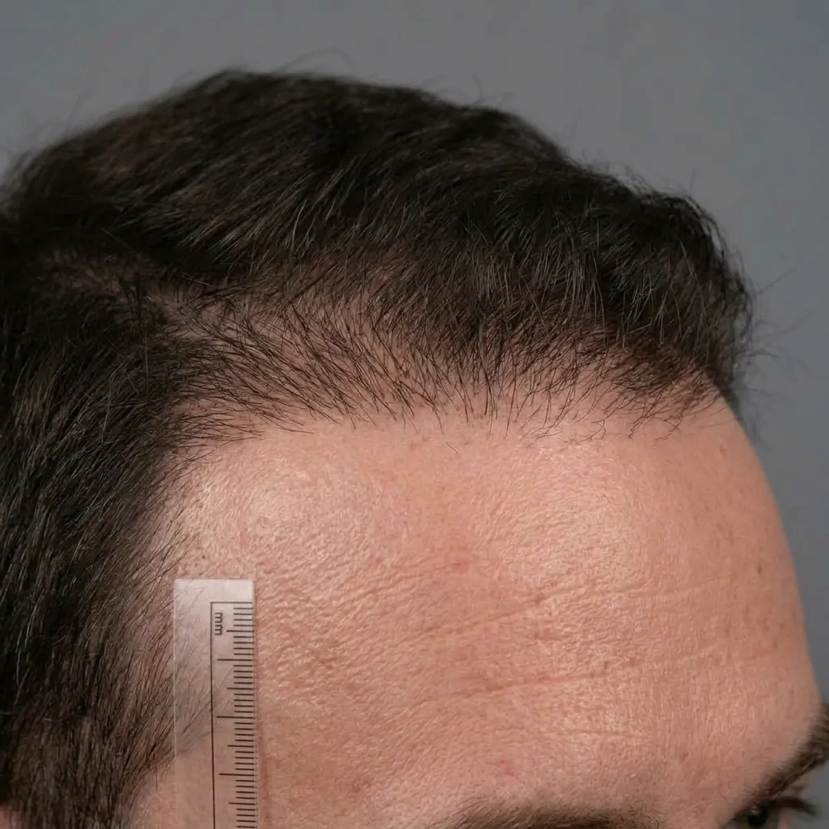 بعد — زراعة شعر، خط أمامي DHI، 10 أشهر