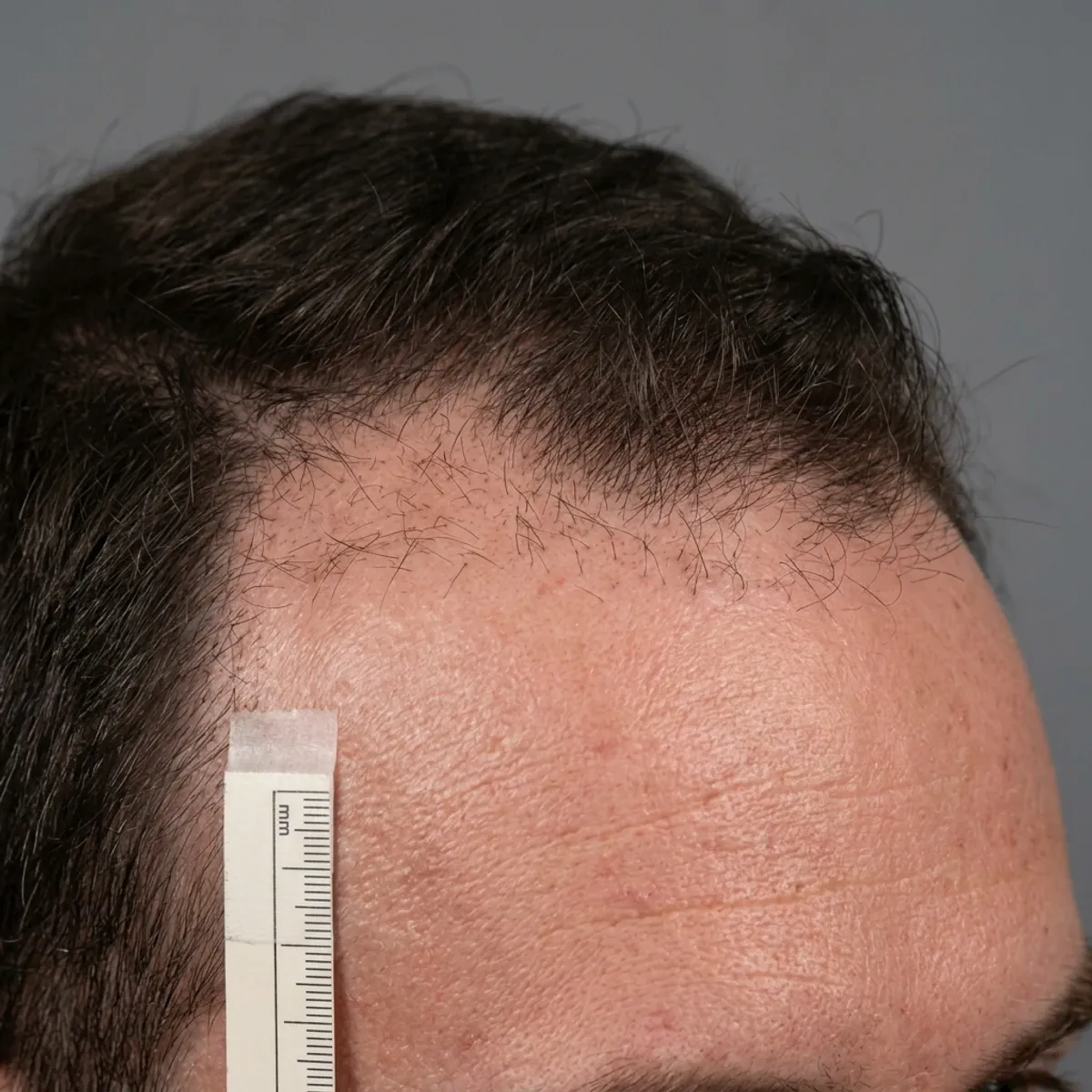 قبل — زراعة شعر، خط أمامي DHI