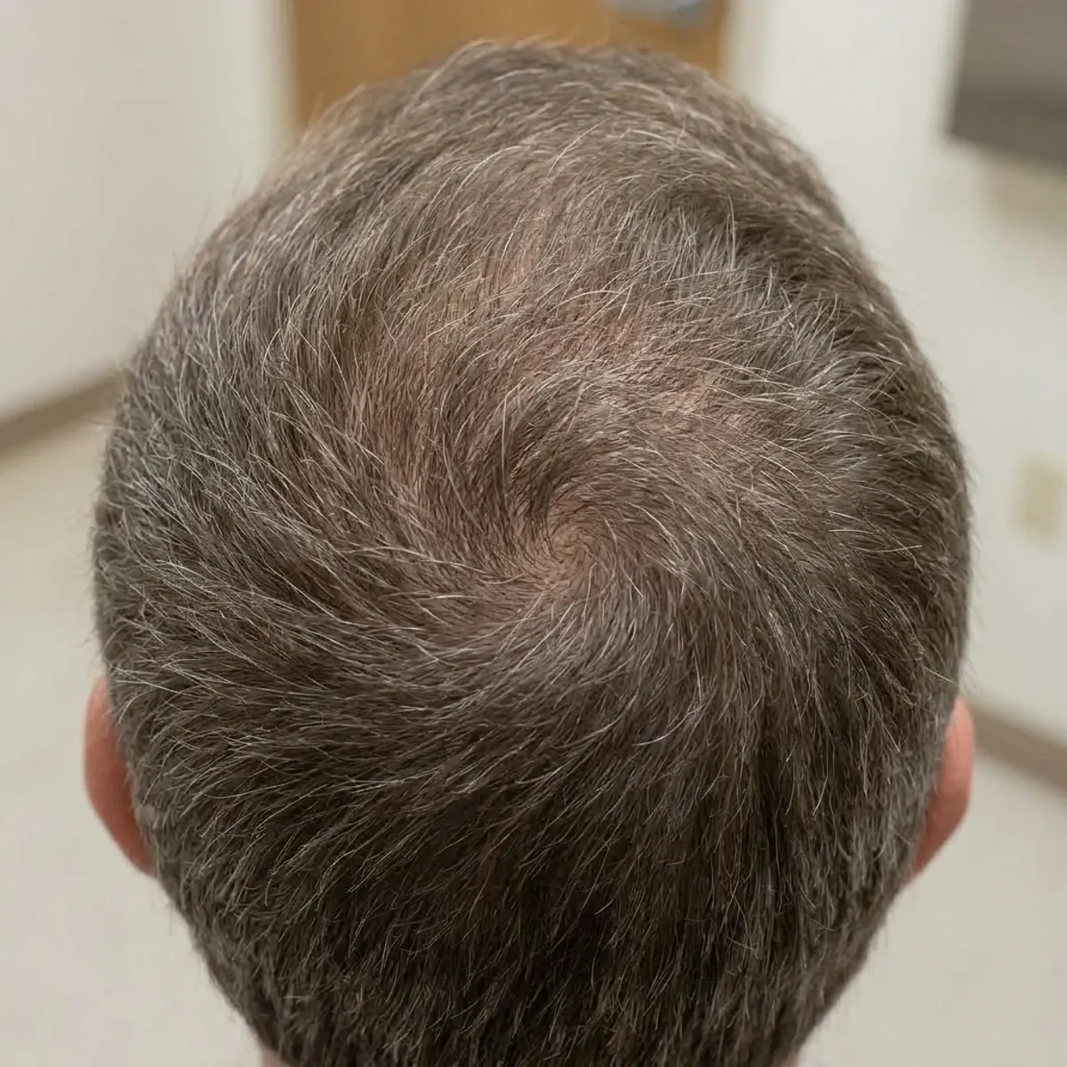 بعد — زراعة شعر، قمة الرأس مكثّفة، 12 شهراً
