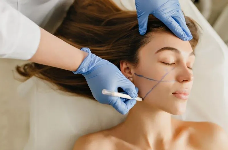 Passage de la microfibre laser Endolift le long de la ligne mandibulaire