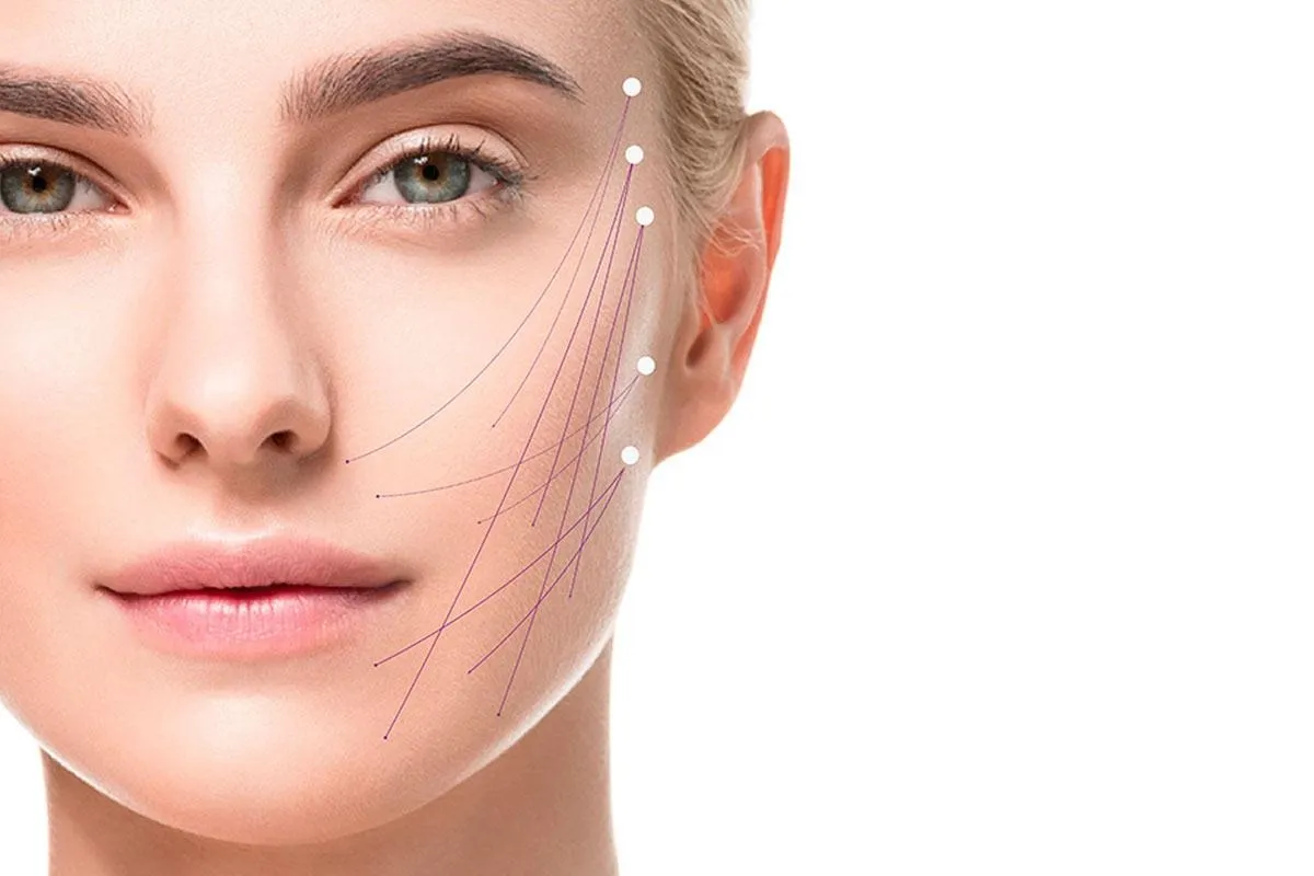 Marquage vectoriel des zones d’action de l’Endolift sur l’ovale du visage