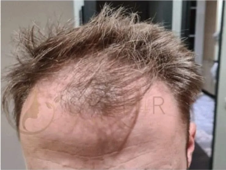 Avant greffe de cheveux