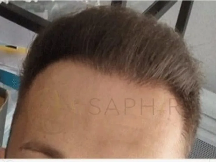 Après greffe de cheveux