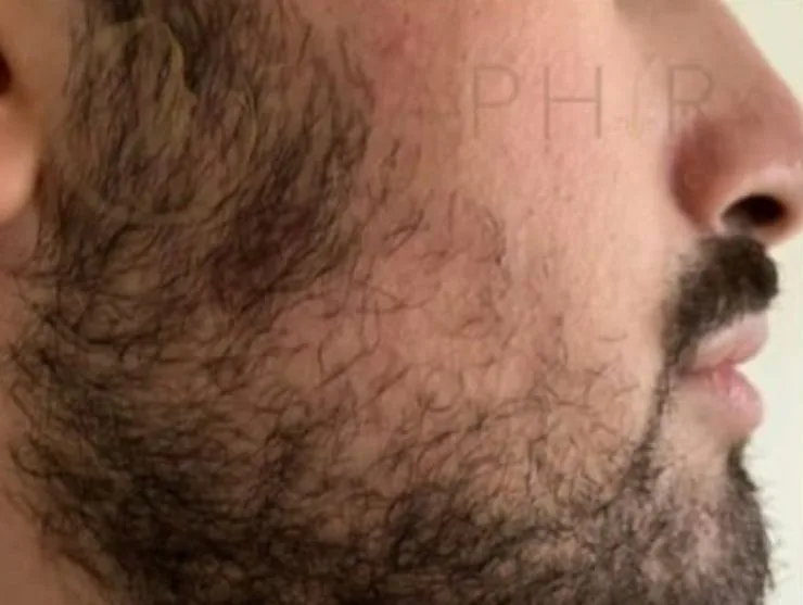 Avant greffe de barbe
