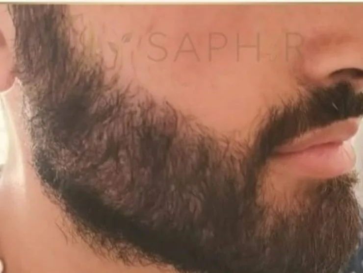 Après greffe de barbe