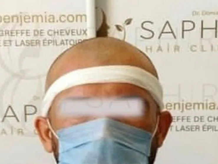 Avant greffe de cheveux