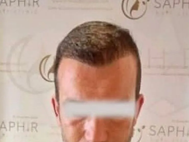 Après greffe de cheveux