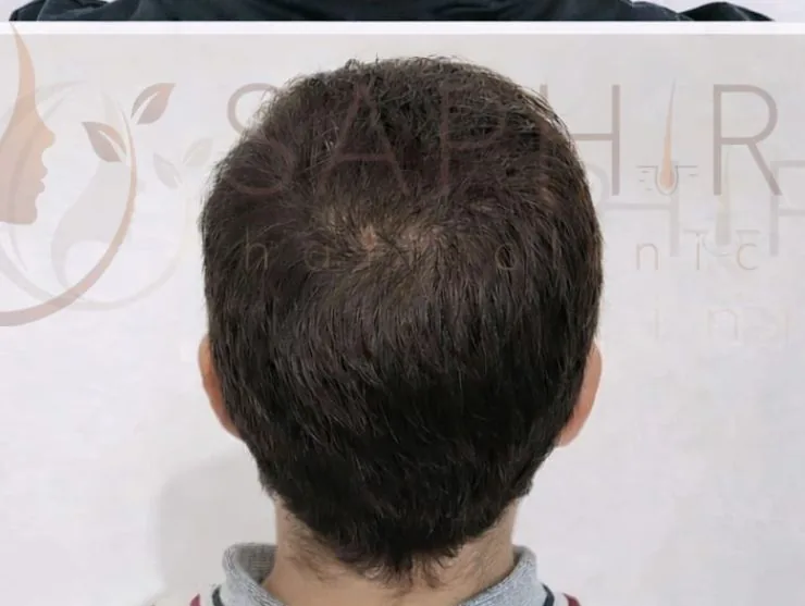 Calvitie étendue : après la greffe de cheveux